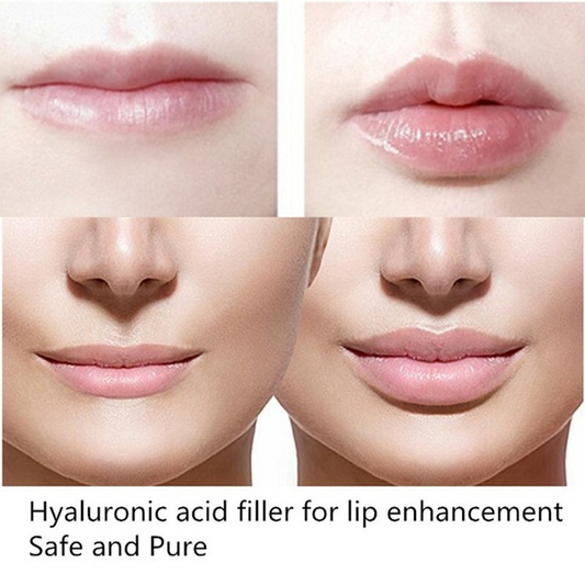 Injection Cross Linked Hyaluronic Acid Filler
