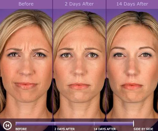 Is botox better when you start playing at a young age?