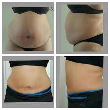 What is injection lipolysis