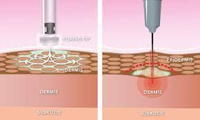 What are the results of injection lipolysis?