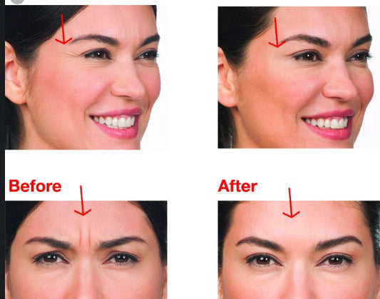 WHAT YOU NEED to KNOW ABOUT DERMAL FILLERS