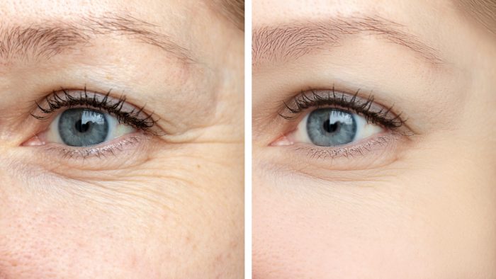 Juvéderm or Botox for Wrinkles: Differences, Results, and Costs