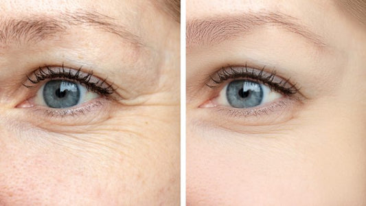 Juvéderm or Botox for Wrinkles: Differences, Results, and Costs