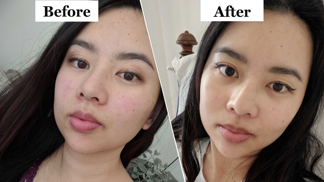 What is Botox?