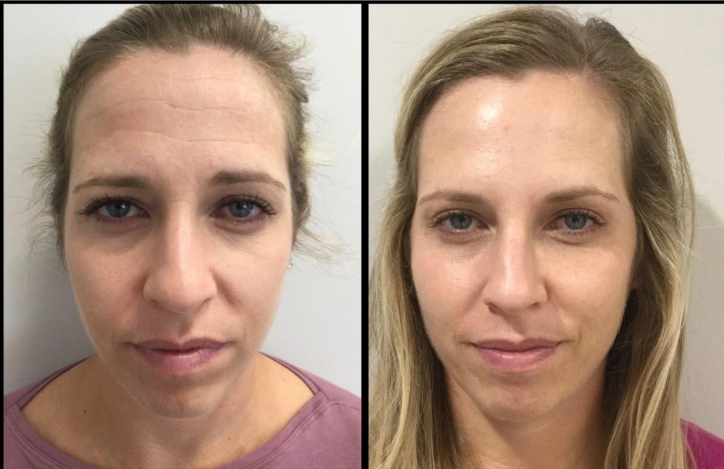 Botox IMPORTANT SAFETY INFORMATION & APPROVED USES