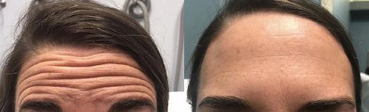 What is Botox (BOTOX®)?