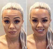 Botox injections