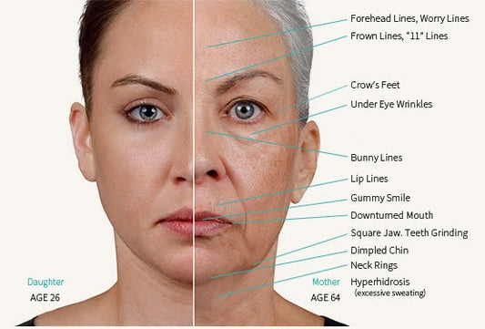 BOTOX