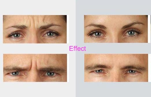 How does Botox work?