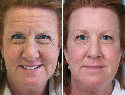 BOTOX® & DYSPORT®