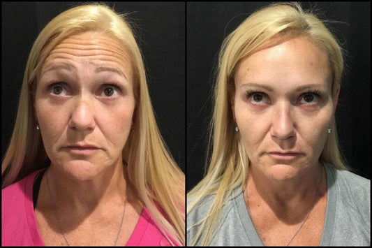 Botox before and after