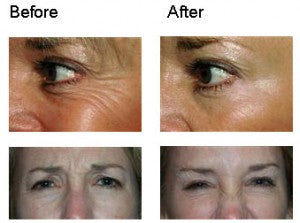 How to use Botox?