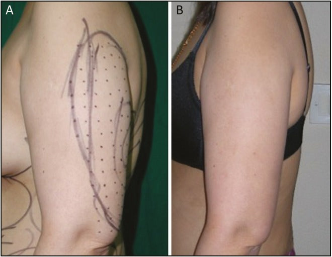 Injection Lipolysis
