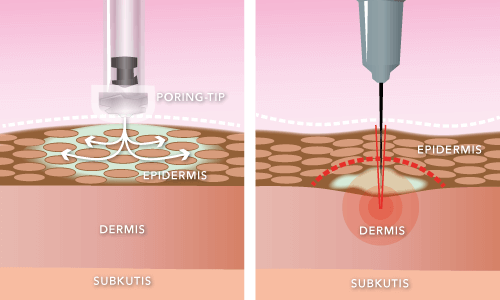Liposuction : A comprehensive review of techniques and safety