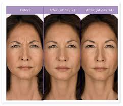Hyaluronic Acid Filler Knee Injection Suppliers and Manufacturers