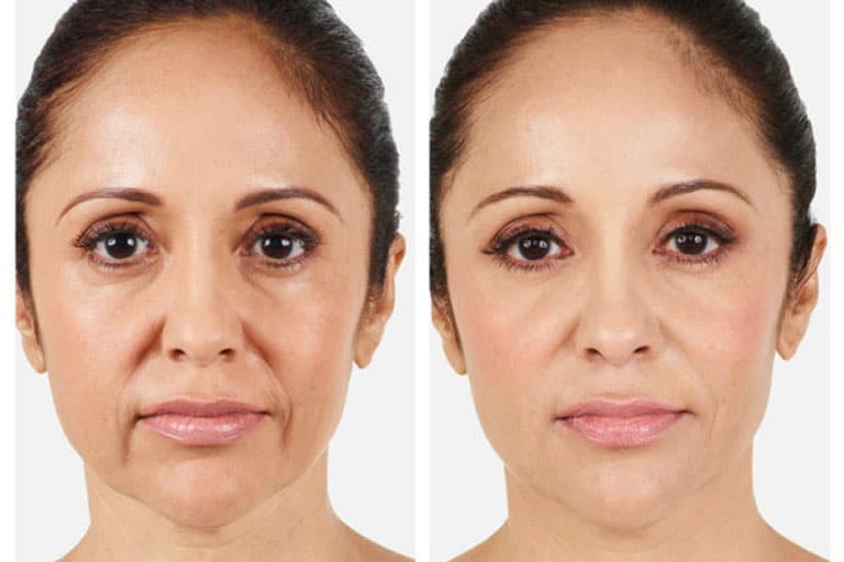 Botox relaxes facial muscles to reduce the appearance of lines and wrinkles