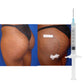 Contrast after butt augmentation