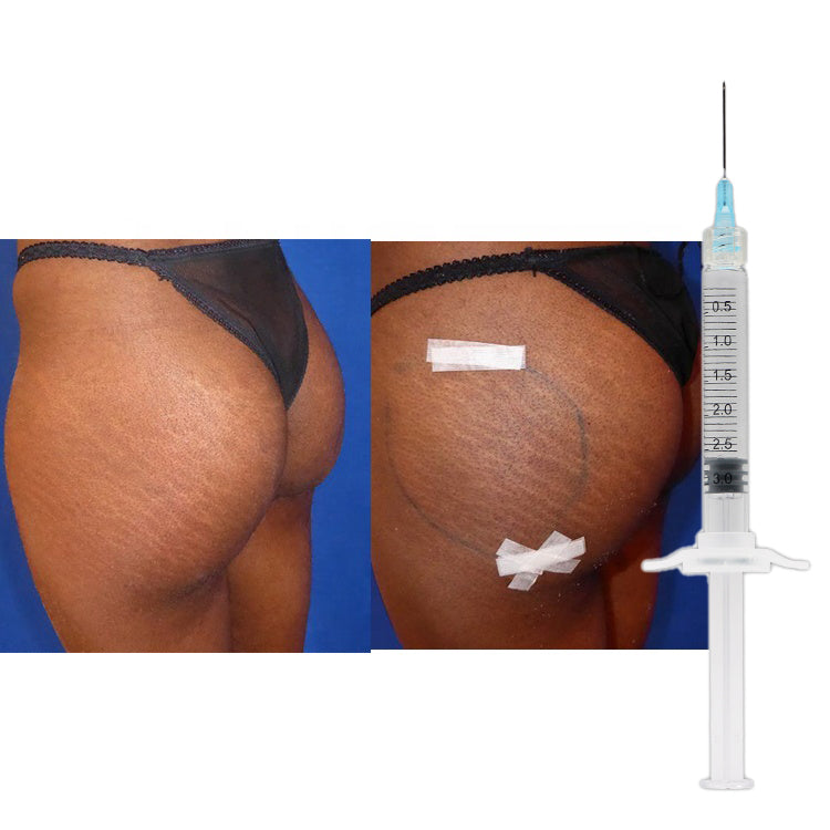 Contrast after butt augmentation